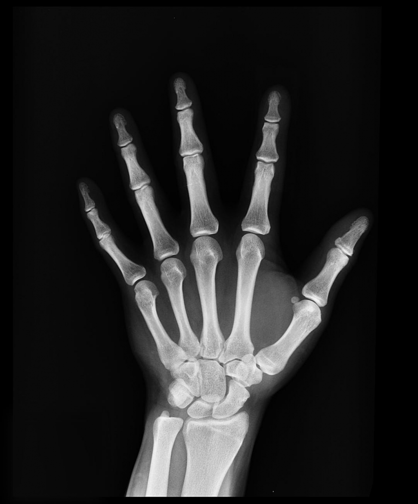Blog: Een breuk aan de vinger of hand, wat nu?